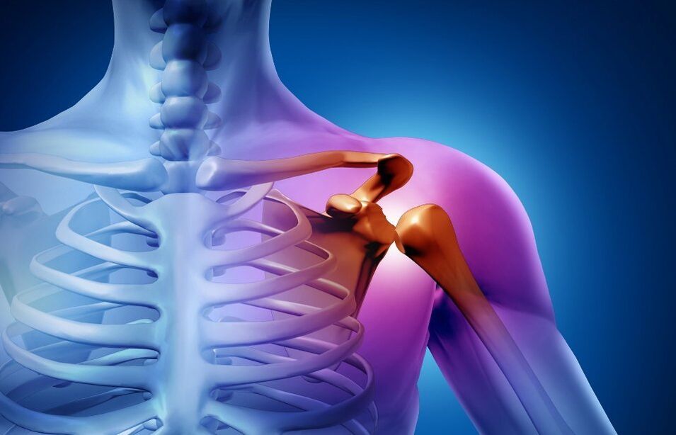 lesión en la articulación del hombro debido a la artrosis