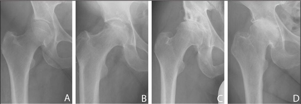 La etapa de desarrollo de la artrosis de la articulación de la cadera en una radiografía. 