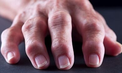 ¿Cuál es la diferencia entre la artritis de la artrosis