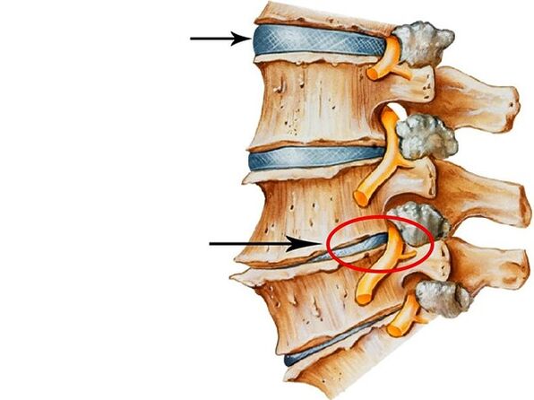 Interrupción en un disco intervertebral