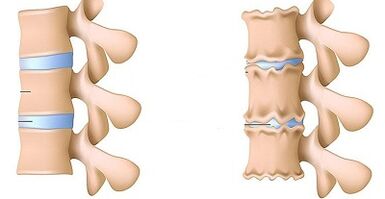 Cómo reconocer la presencia de osteocondrosis lumbar